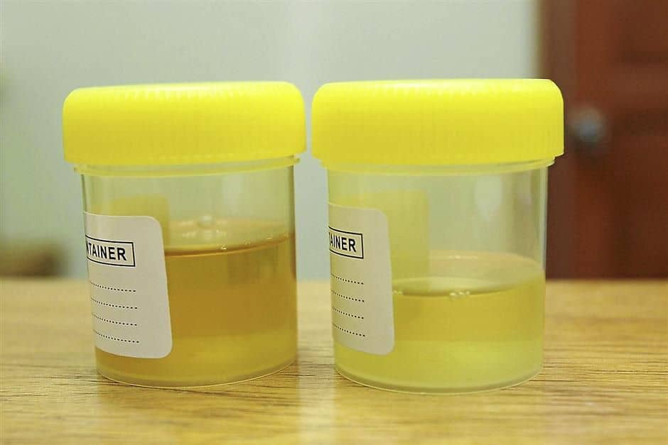 Cloudy Urine In Early Pregnancy : Should I Be Worried?